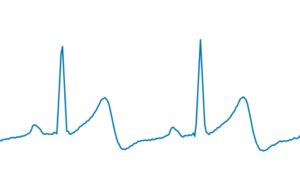 Image of a good ECG signal